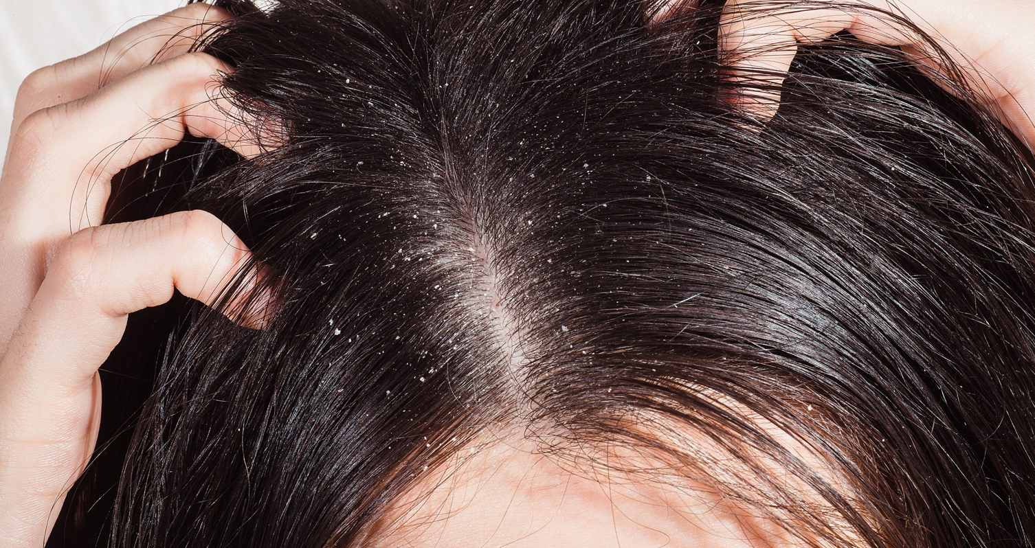 Mascarilla casera anticaspa para el pelo