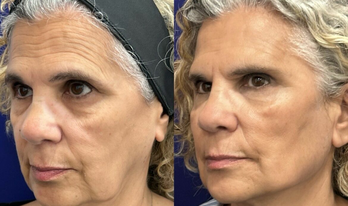 Global Face: nuevo protocolo integral del Dr. Ángel Martín para la recuperación de estructuras faciales, de la firmeza y elasticidad dérmica