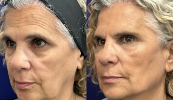 Global Face: nuevo protocolo integral del Dr. Ángel Martín para la recuperación de estructuras faciales, de la firmeza y elasticidad dérmica