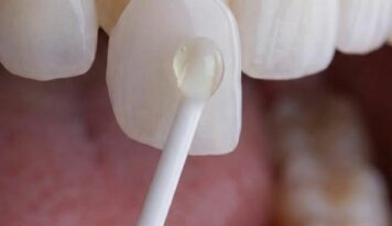 Instituto Volpe presenta Skin Finea®, carillas ultrafinas que preservan el diente propio al 100%