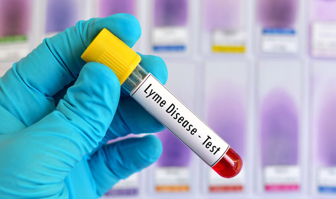 Pruebas para detectar la enfermedad de Lyme